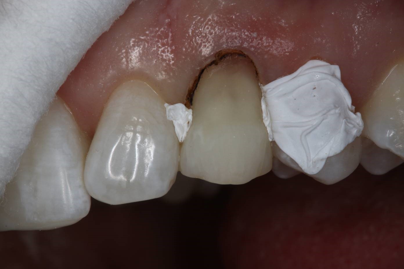 The Use Of Lasers In Dentistry Gingivectomy By Diode Laser Optident
